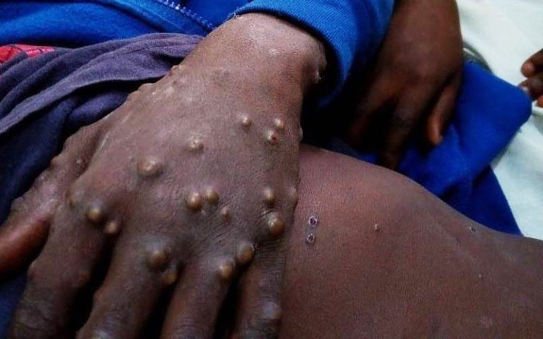 Maniema : Un nouveau cas de contamination par monkey pox testé positif à Kibombo