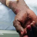 Mpox en RDC : après l’urgence, les provinces face au test de la surveillance