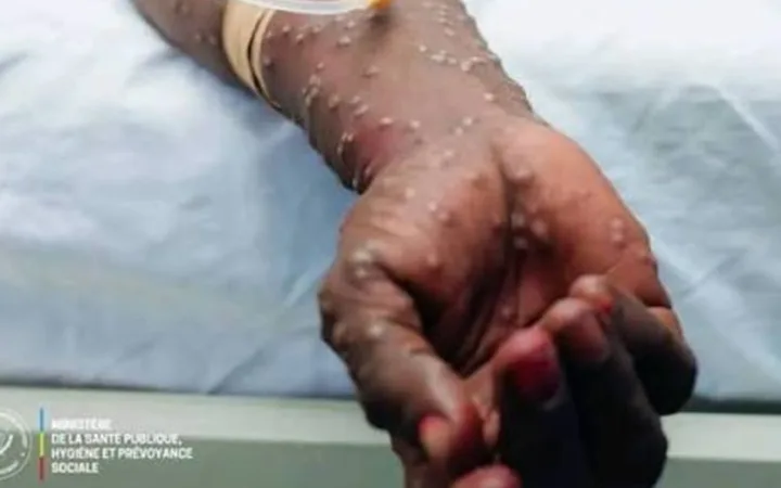 Mpox en RDC : après l’urgence, les provinces face au test de la surveillance