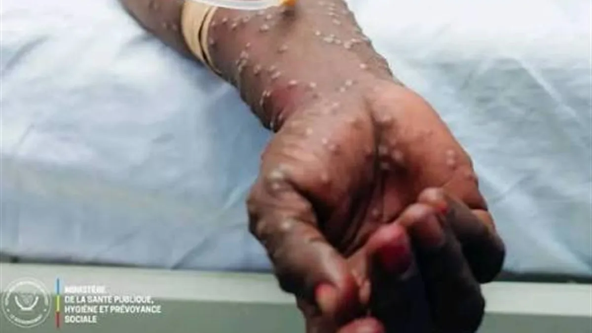 Mpox en RDC : après l’urgence, les provinces face au test de la surveillance