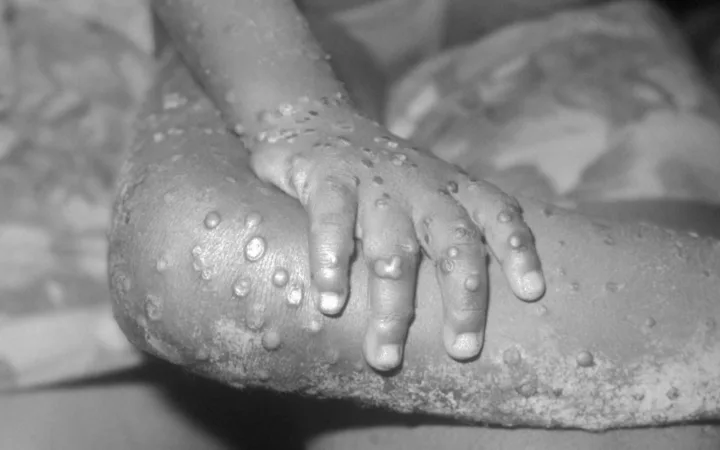 Kasaï : 22 cas suspects de mpox et trois décès signalés à Luebo