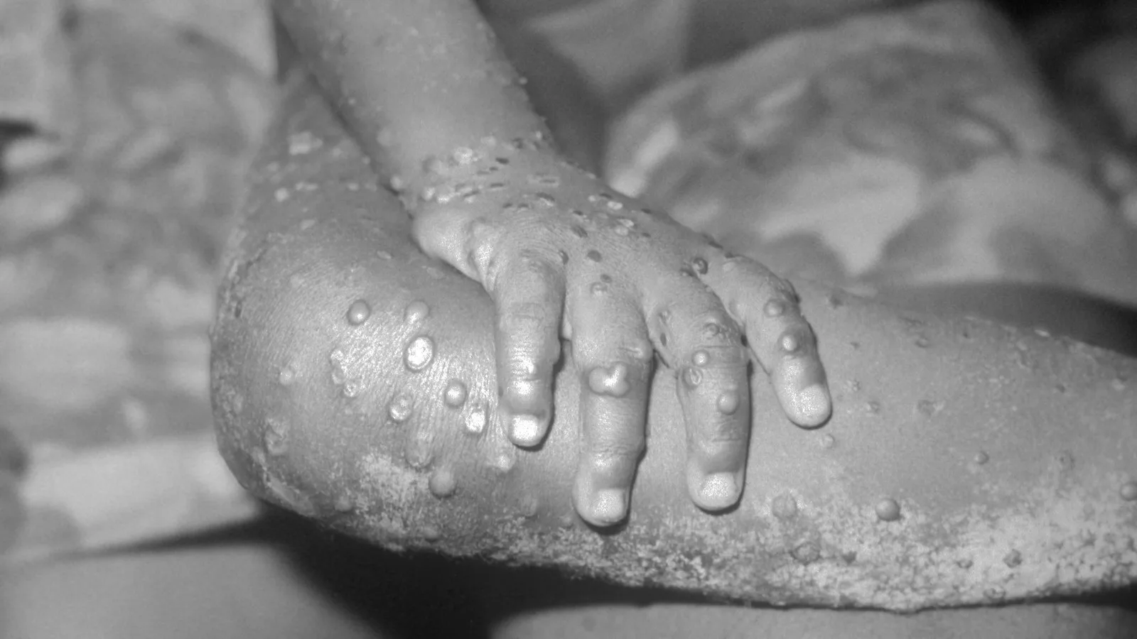 Kasaï : 22 cas suspects de mpox et trois décès signalés à Luebo